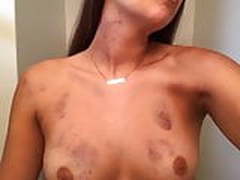 Teen Shows off her Brown Roughed up Tits 2
